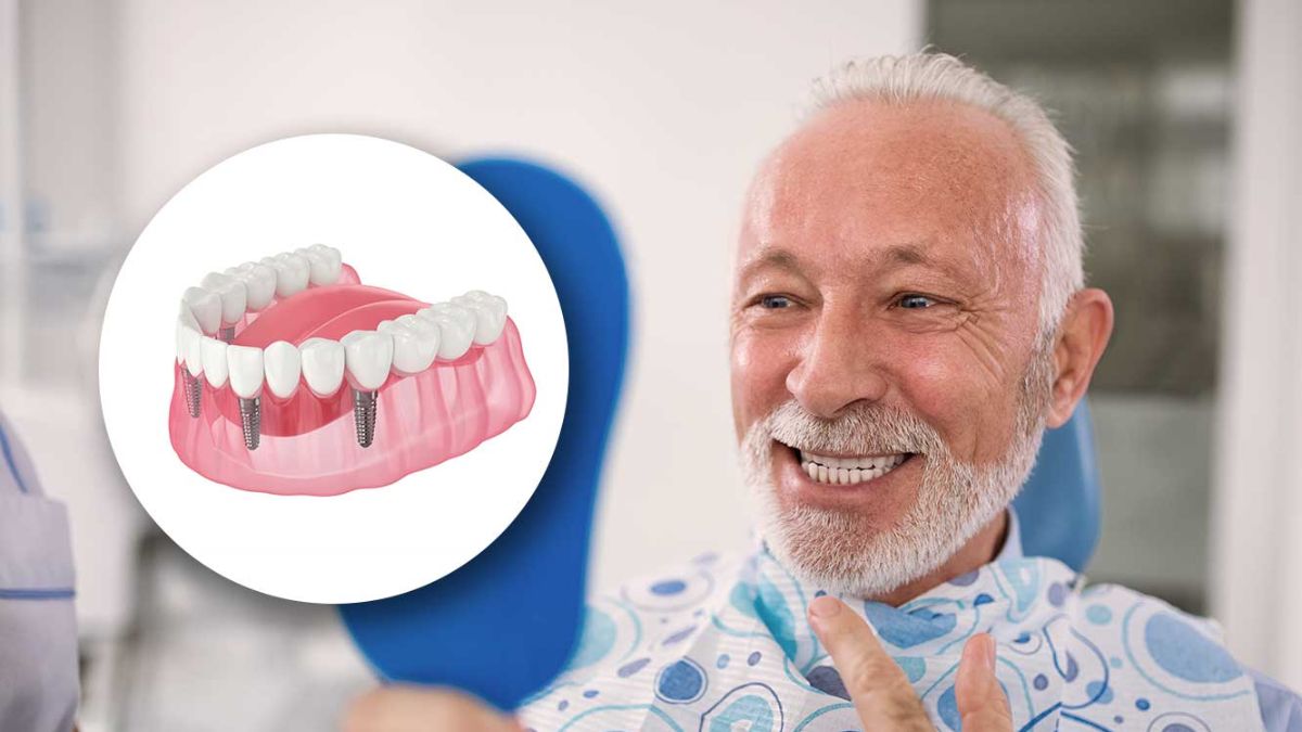 Dental Implants